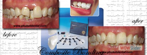 composite_bonding02