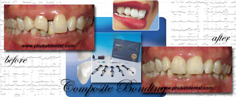 Composite Filing/Dental Bonding