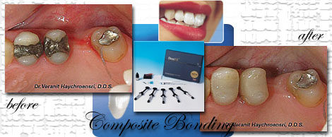Composite Filing/Dental Bonding