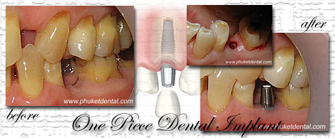 Dental Implants by Phuket Dentist at Phuket Dental Clinic in Phuket,Thailand