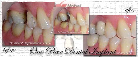 dental implant