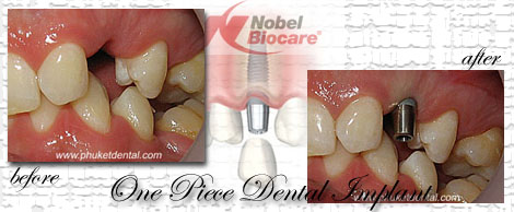 Dental Implants by Phuket Dentist at Phuket Dental Clinic in Phuket,Thailand