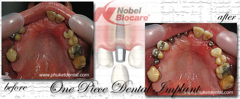 Dental Implants by Phuket Dentist at Phuket Dental Clinic in Phuket,Thailand