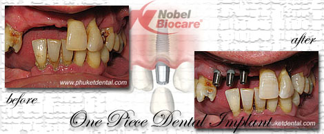 Dental Implants by Phuket Dentist at Phuket Dental Clinic in Phuket,Thailand