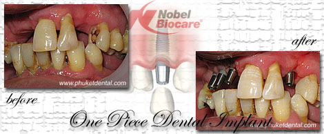 Dental Implants by Phuket Dentist at Phuket Dental Clinic in Phuket,Thailand