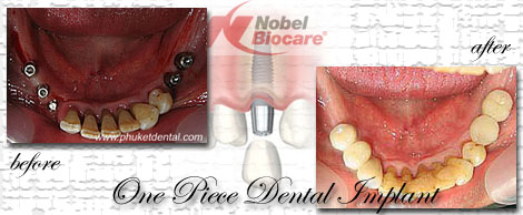 Dental Implants by Phuket Dentist at Phuket Dental Clinic in Phuket,Thailand