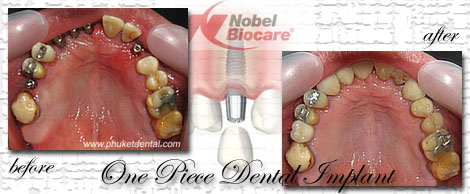 Dental Implants by Phuket Dentist at Phuket Dental Clinic in Phuket,Thailand