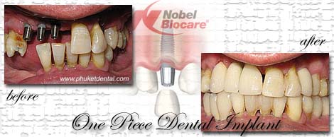 Dental Implants by Phuket Dentist at Phuket Dental Clinic in Phuket,Thailand