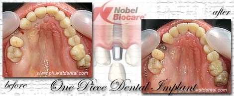 Dental Implants by Phuket Dentist at Phuket Dental Clinic in Phuket,Thailand