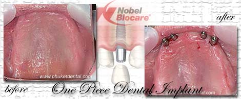 Dental Implants by Phuket Dentist at Phuket Dental Clinic in Phuket,Thailand