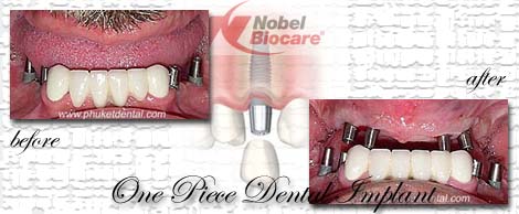 Dental Implants by Phuket Dentist at Phuket Dental Clinic in Phuket,Thailand
