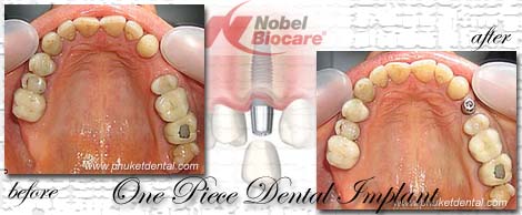 Dental Implants by Phuket Dentist at Phuket Dental Clinic in Phuket,Thailand