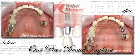 Dental Implants by Phuket Dentist at Phuket Dental Clinic in Phuket,Thailand