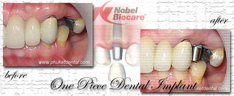 Dental Implants by Phuket Dentist at Phuket Dental Clinic in Phuket,Thailand