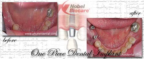 Dental Implants by Phuket Dentist at Phuket Dental Clinic in Phuket,Thailand