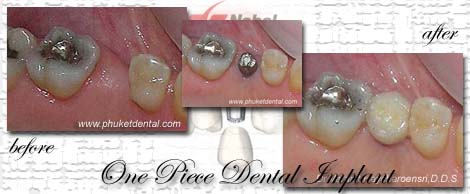 Dental Implants by Phuket Dentist at Phuket Dental Clinic in Phuket,Thailand