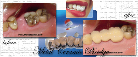 Ceramic/Titanium crowns&bridges by Phuket Dentist at Phuket Dental Clinic in Phuket,Thailand