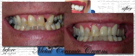 Ceramic/Titanium crowns&bridges by Phuket Dentist at Phuket Dental Clinic in Phuket,Thailand