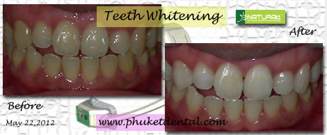 Tooth Whitening:non-LASER,LED,Natural Plus at Phuket Dental Clinic,Thailand