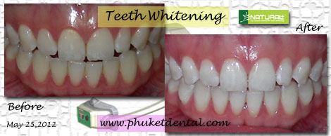 laser teeth whitening thailand reviews