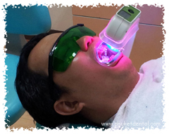 Natural Plus Tooth Whitening in Phuket,Thailand