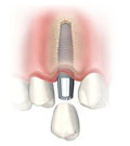 Nobel biocare dental implant